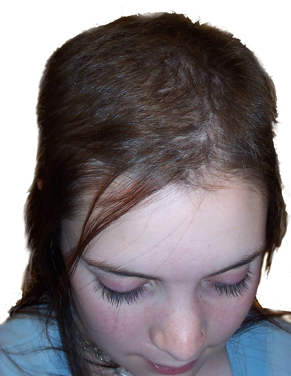Before Picture - Trichotillomania Success Story